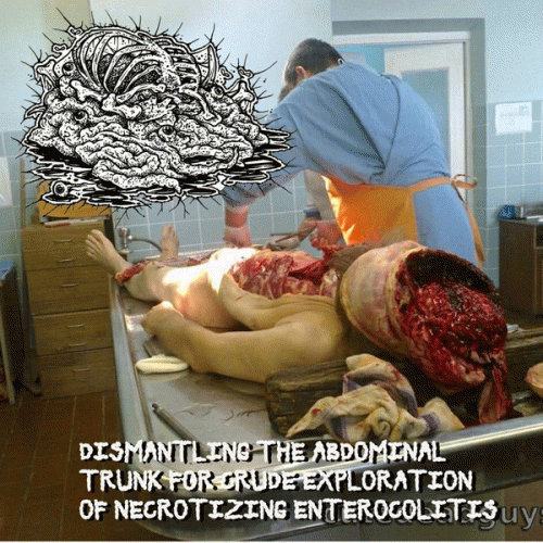 Botched Anastomosis J-Pouch : Dismantling the Abdominal Trunk for Crude Exploration of Necrotizing Enterocolitis